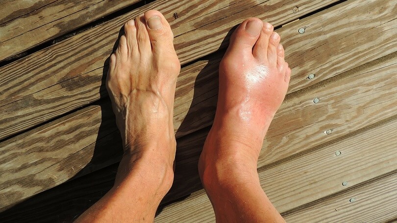 Difference Between Gout and Turf Toe