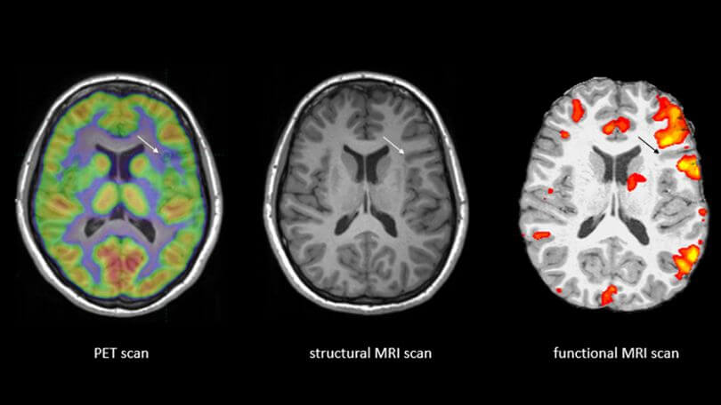 Difference Between MRI and fMRI